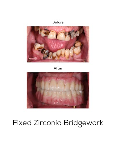 Fixed Implant Bridgework Before & After Gallery - Patient 398652 - Image 1