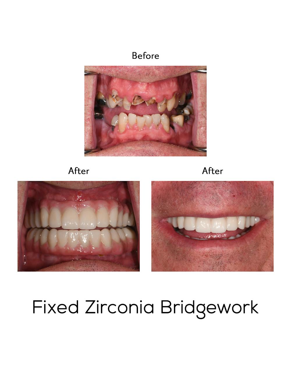 Fixed Implant Bridgework Before & After Gallery - Patient 169129 - Image 1
