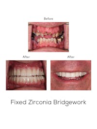 Fixed Implant Bridgework Before & After Gallery - Patient 169129 - Image 1