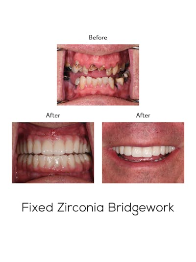 Fixed Implant Bridgework Before & After Gallery - Patient 169129 - Image 1