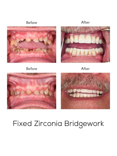 Fixed Implant Bridgework Before & After Gallery - Patient 401470 - Image 1
