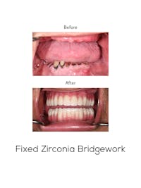 Fixed Implant Bridgework Before & After Gallery - Patient 369304 - Image 1