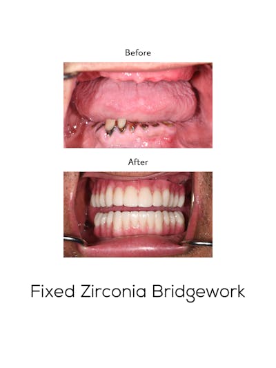 Fixed Implant Bridgework Before & After Gallery - Patient 369304 - Image 1