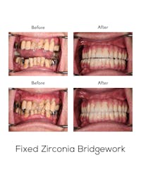 Fixed Implant Bridgework Before & After Gallery - Patient 114594 - Image 1