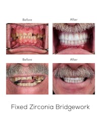 Fixed Implant Bridgework Before & After Gallery - Patient 254166 - Image 1