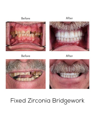 Fixed Implant Bridgework Before & After Gallery - Patient 254166 - Image 1