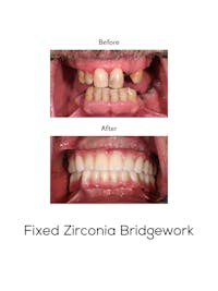 Fixed Implant Bridgework Before & After Gallery - Patient 155399 - Image 1