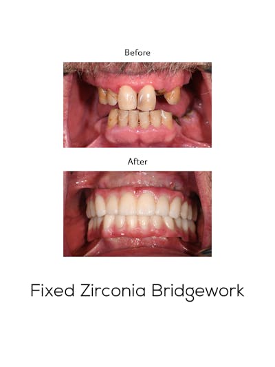 Fixed Implant Bridgework Before & After Gallery - Patient 155399 - Image 1