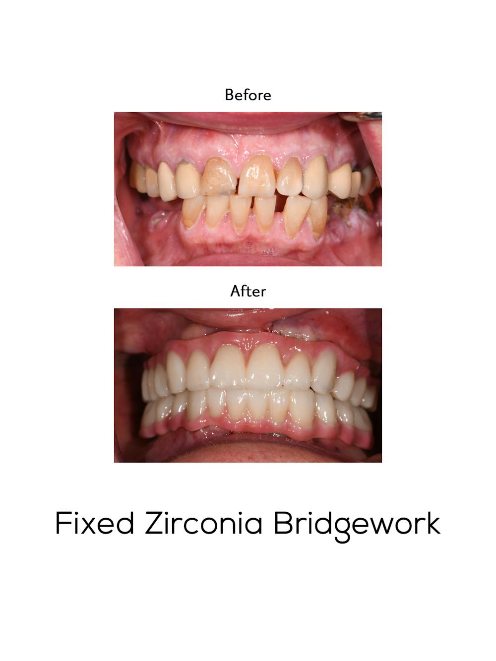 Fixed Implant Bridgework Before & After Gallery - Patient 173765 - Image 1