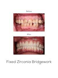 Fixed Implant Bridgework Before & After Gallery - Patient 173765 - Image 1