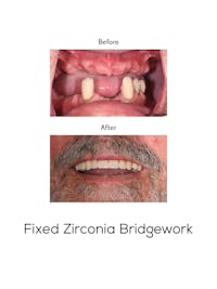 Fixed Implant Bridgework Before & After Gallery - Patient 346576 - Image 1