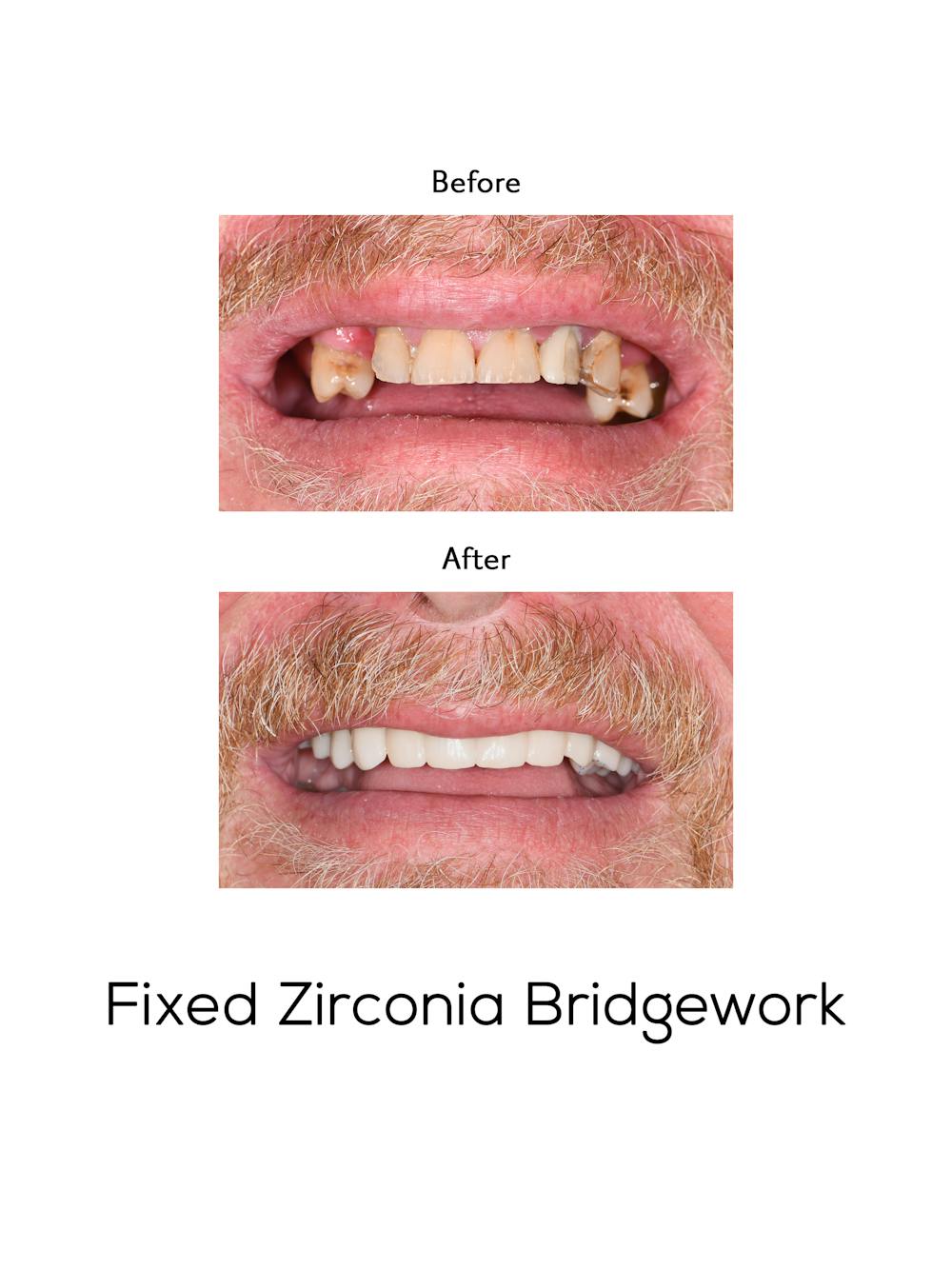 Fixed Implant Bridgework Before & After Gallery - Patient 337002 - Image 1
