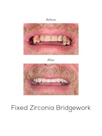 Fixed Implant Bridgework Before & After Gallery - Patient 337002 - Image 1