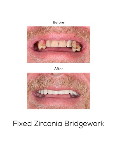 Fixed Implant Bridgework Before & After Gallery - Patient 337002 - Image 1