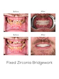 Fixed Implant Bridgework Before & After Gallery - Patient 347872 - Image 1