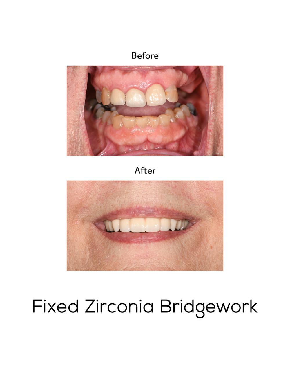 Fixed Implant Bridgework Before & After Gallery - Patient 385882 - Image 1