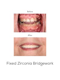 Fixed Implant Bridgework Before & After Gallery - Patient 385882 - Image 1