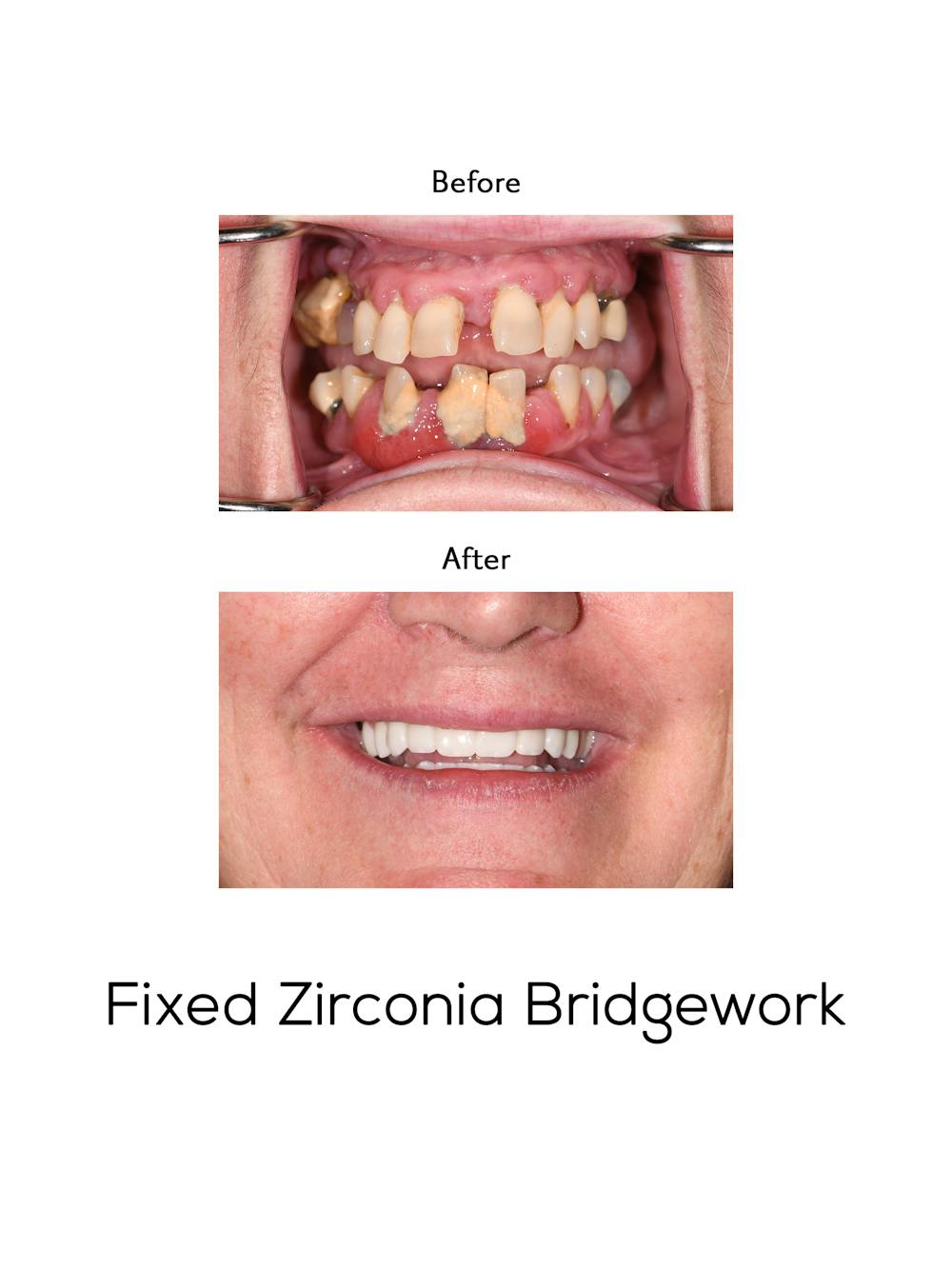 Fixed Implant Bridgework Before & After Gallery - Patient 738102 - Image 1