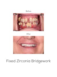 Fixed Implant Bridgework Before & After Gallery - Patient 738102 - Image 1