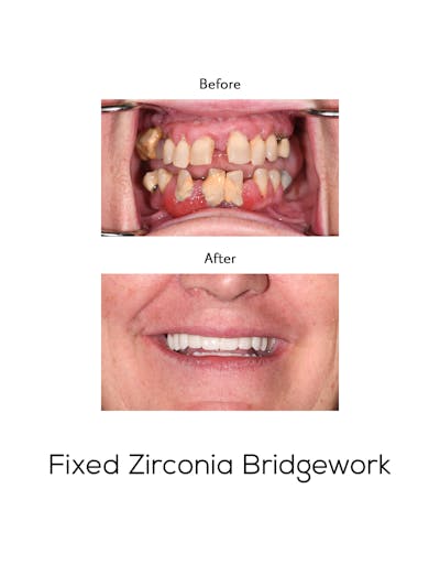 Fixed Implant Bridgework Before & After Gallery - Patient 738102 - Image 1