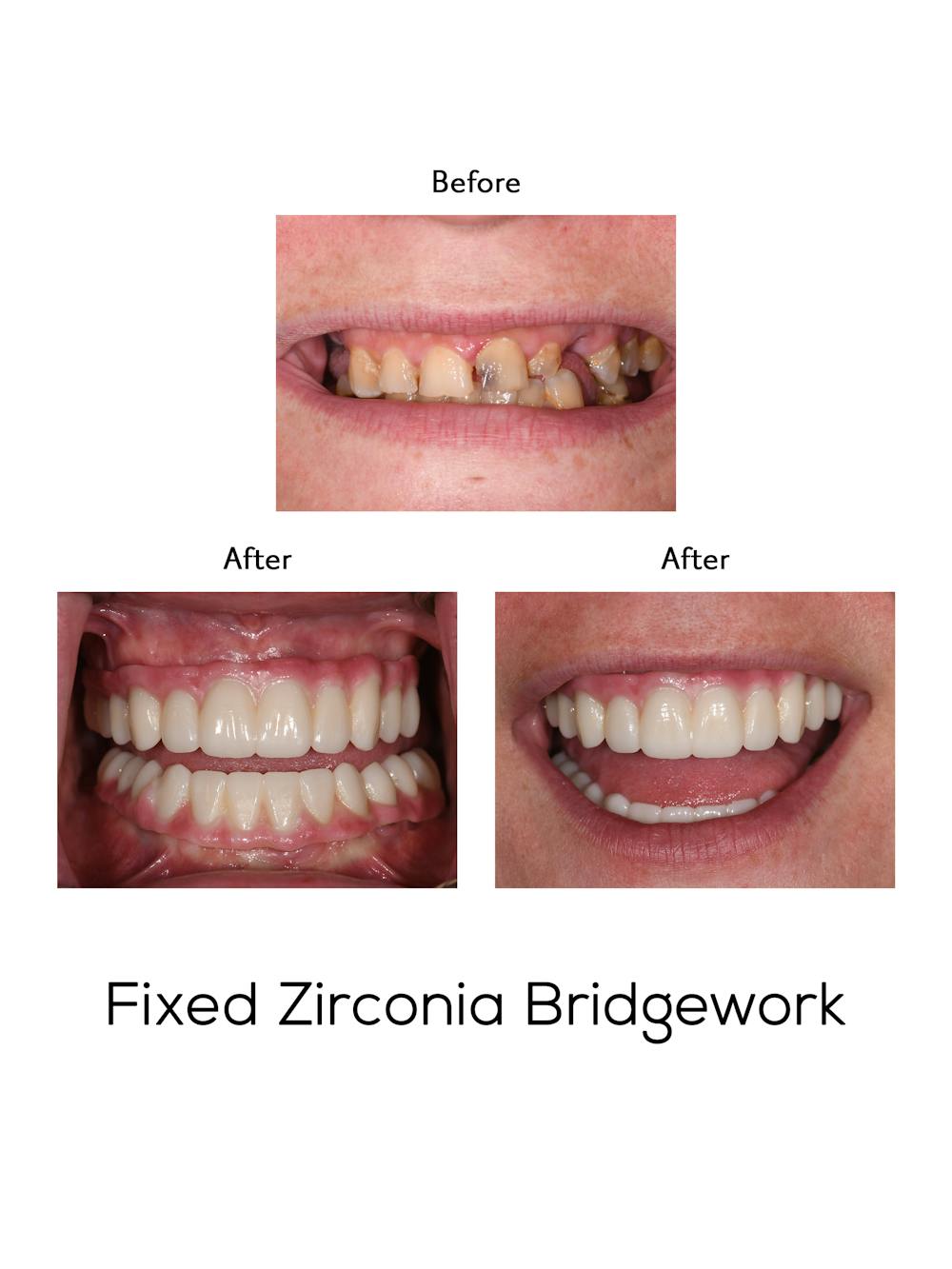 Fixed Implant Bridgework Before & After Gallery - Patient 111136 - Image 1