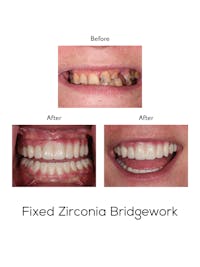 Fixed Implant Bridgework Before & After Gallery - Patient 111136 - Image 1
