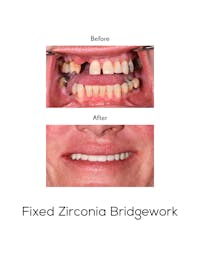 Fixed Implant Bridgework Before & After Gallery - Patient 205832 - Image 1