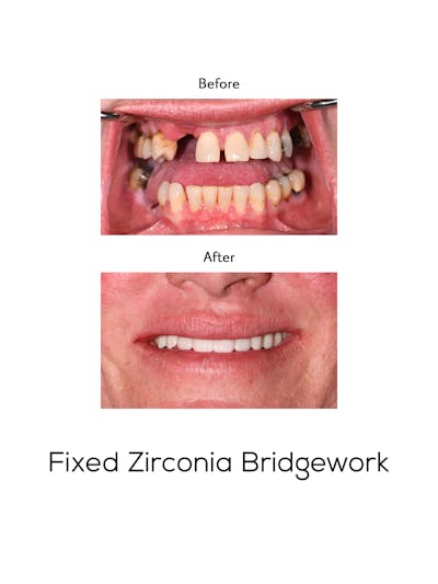 Fixed Implant Bridgework Before & After Gallery - Patient 205832 - Image 1
