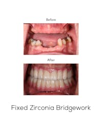 Fixed Implant Bridgework Before & After Gallery - Patient 118832 - Image 1