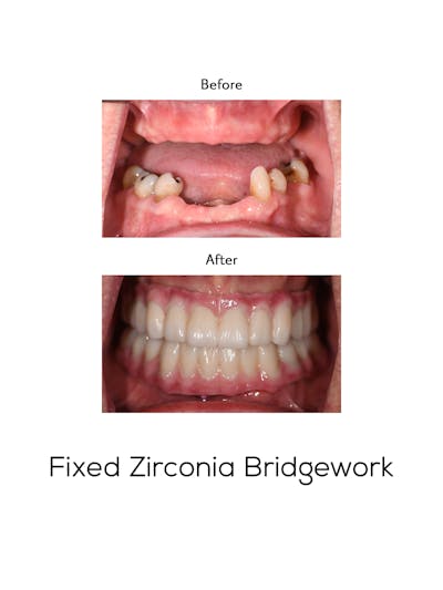 Fixed Implant Bridgework Before & After Gallery - Patient 118832 - Image 1