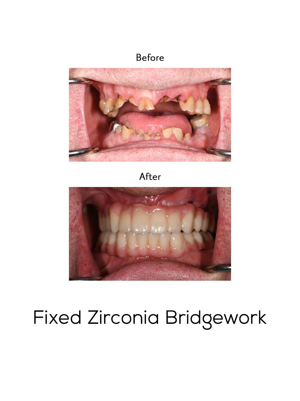 Fixed Implant Bridgework Before & After Gallery - Patient 249576 - Image 1