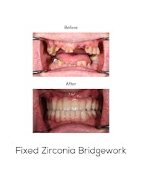 Fixed Implant Bridgework Before & After Gallery - Patient 249576 - Image 1