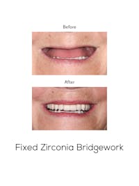 Fixed Implant Bridgework Before & After Gallery - Patient 181146 - Image 1
