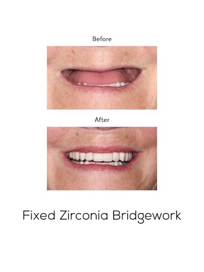 Fixed Implant Bridgework Before & After Gallery - Patient 181146 - Image 1
