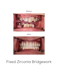 Fixed Implant Bridgework Before & After Gallery - Patient 152793 - Image 1