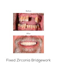 Fixed Implant Bridgework Before & After Gallery - Patient 198707 - Image 1