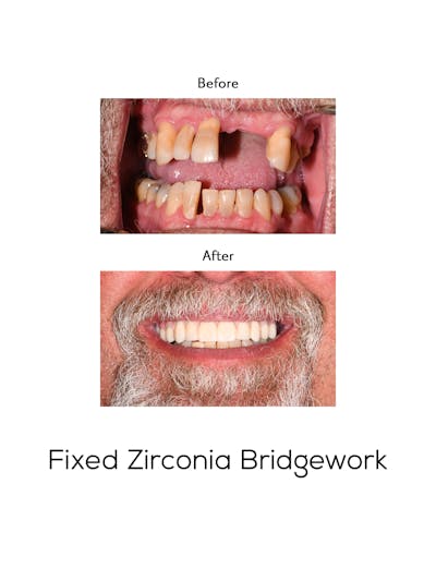 Fixed Implant Bridgework Before & After Gallery - Patient 198707 - Image 1