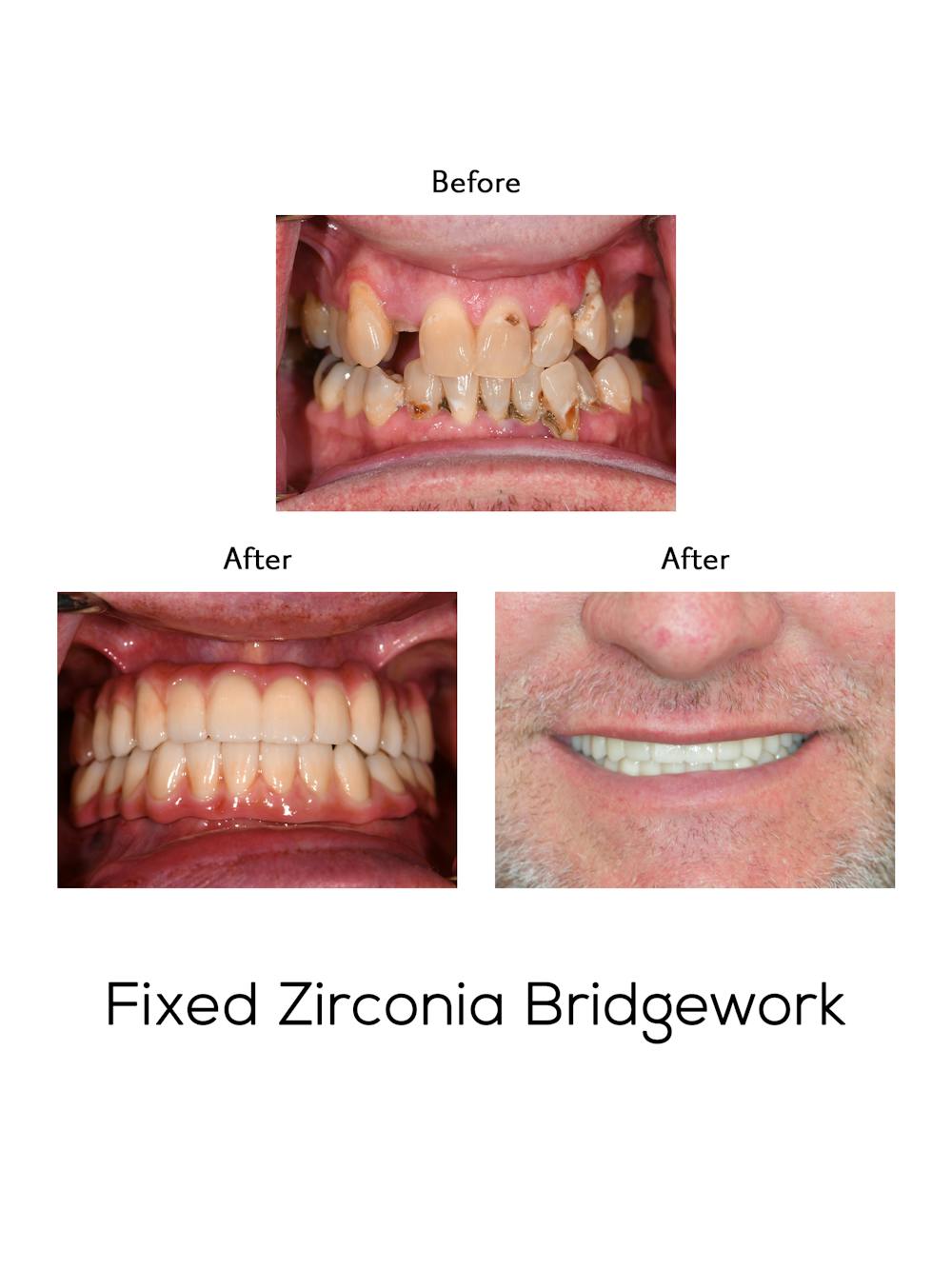 Fixed Implant Bridgework Before & After Gallery - Patient 122125 - Image 1