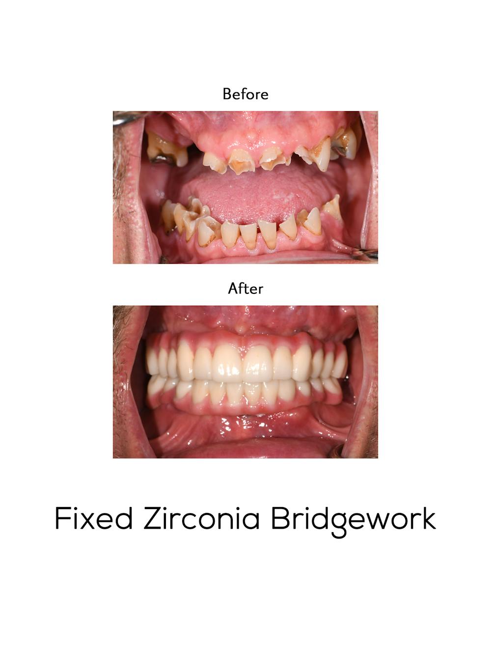 Fixed Implant Bridgework Before & After Gallery - Patient 262212 - Image 1