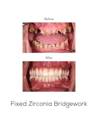 Fixed Implant Bridgework Before & After Gallery - Patient 262212 - Image 1