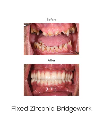Fixed Implant Bridgework Before & After Gallery - Patient 262212 - Image 1