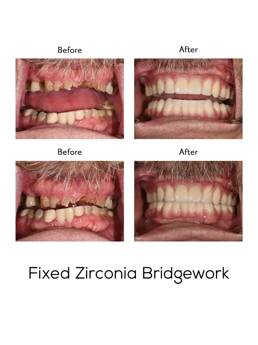 Fixed Implant Bridgework Before & After Gallery - Patient 325216 - Image 1