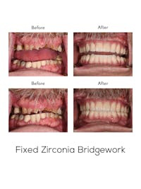 Fixed Implant Bridgework Before & After Gallery - Patient 325216 - Image 1