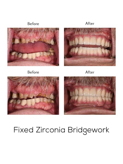 Fixed Implant Bridgework Before & After Gallery - Patient 325216 - Image 1