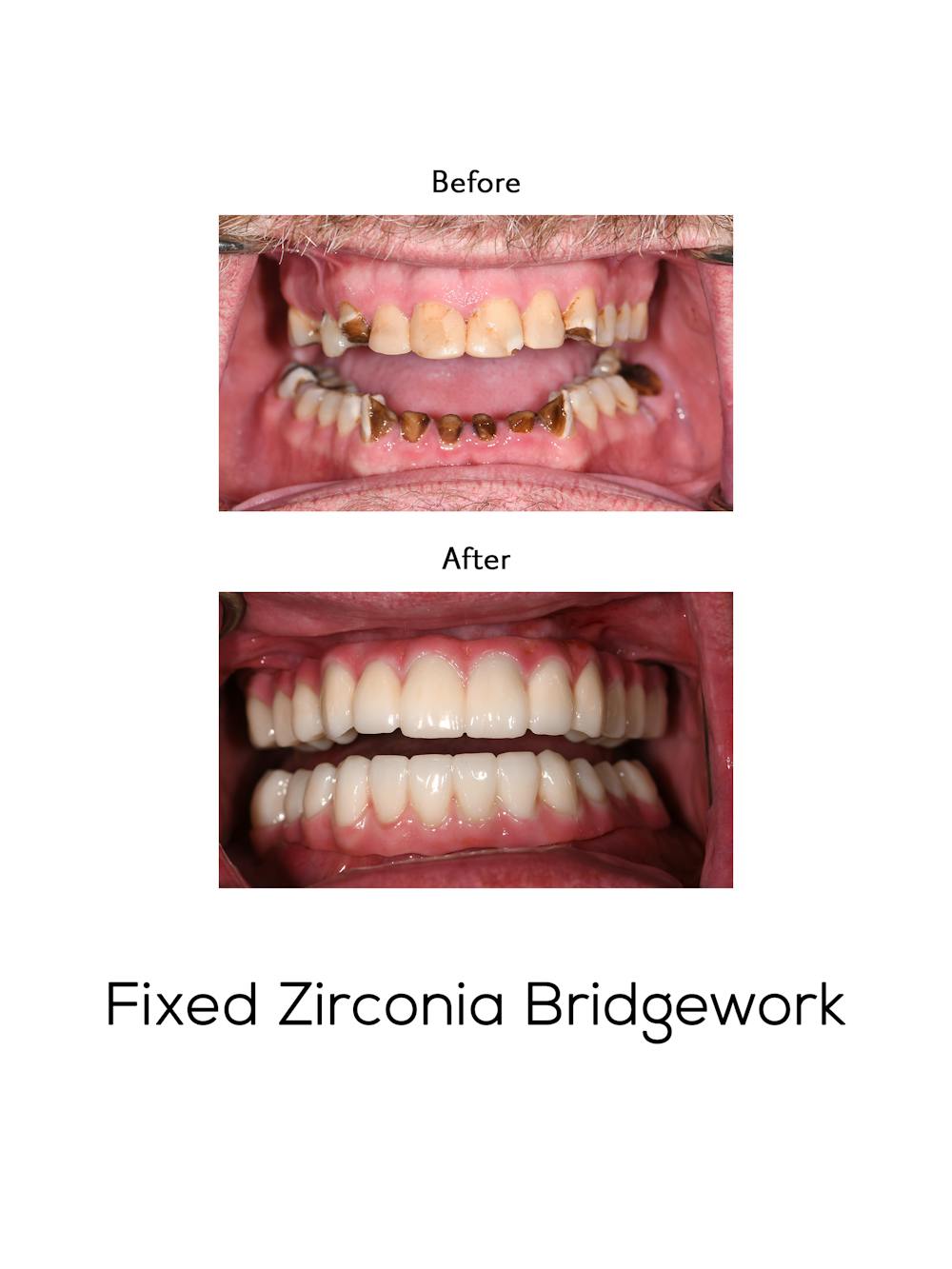 Fixed Implant Bridgework Before & After Gallery - Patient 275932 - Image 1