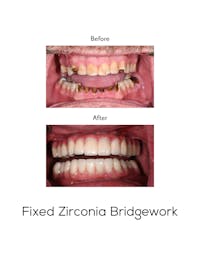 Fixed Implant Bridgework Before & After Gallery - Patient 275932 - Image 1