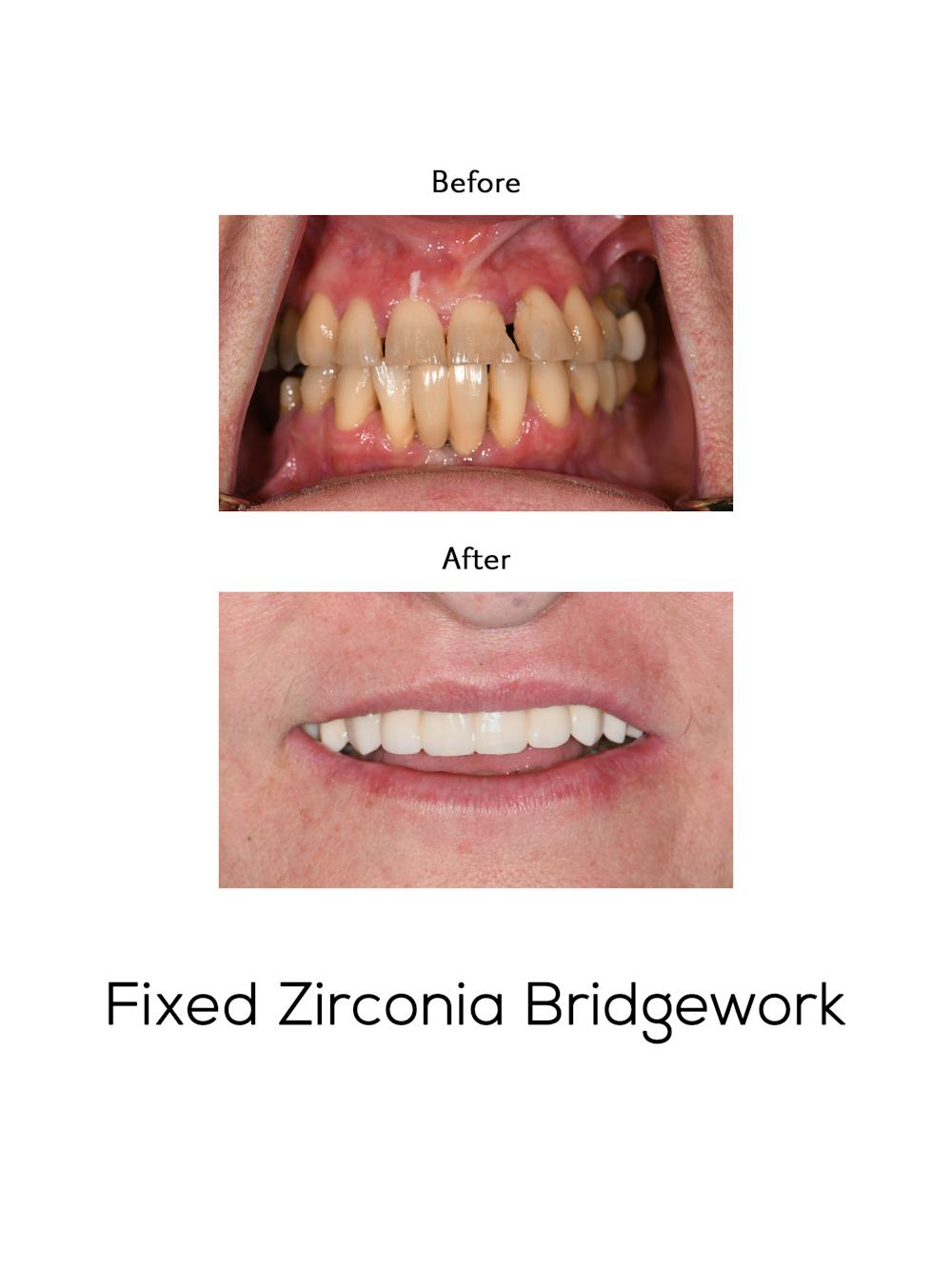 Fixed Implant Bridgework Before & After Gallery - Patient 582253 - Image 1