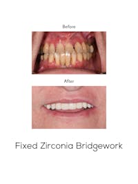 Fixed Implant Bridgework Before & After Gallery - Patient 582253 - Image 1