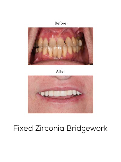 Fixed Implant Bridgework Before & After Gallery - Patient 582253 - Image 1