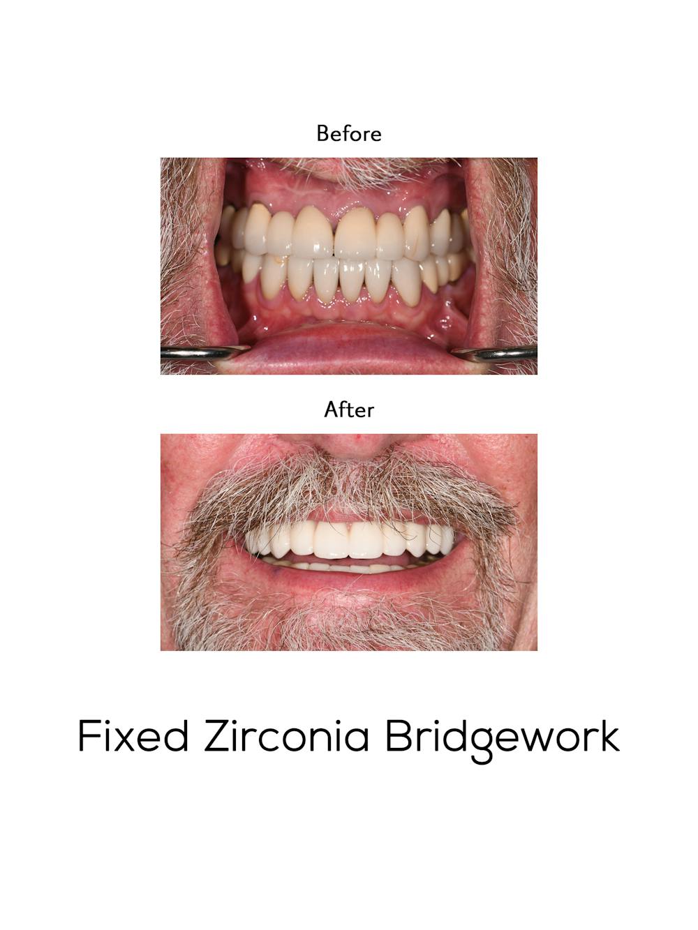 Fixed Implant Bridgework Before & After Gallery - Patient 593040 - Image 1